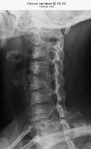 Neck Fusions After A Car Accident - Cullotta Law